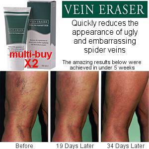 Vein Eraser Thread Vein Treatment Cream Multi-Buy (100ml x 2)