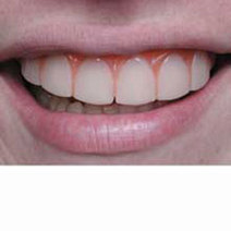 Unbranded CARTOON TEETH